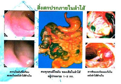 D-Toc Raspberry (ดีท็อค กลิ่นราสเบอร์รี่) ล้างสารพิษในลำไส้ โดยไม่ต้องสวนลำไส้